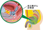 前立腺がん